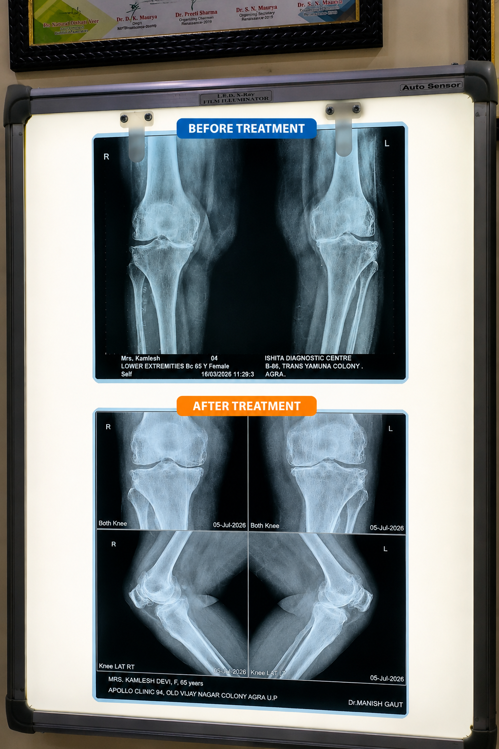 AyurORTHO knee patient success story